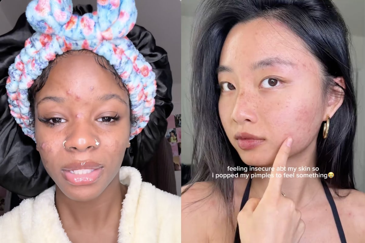 I went viral for acne content – then my pimples disappeared