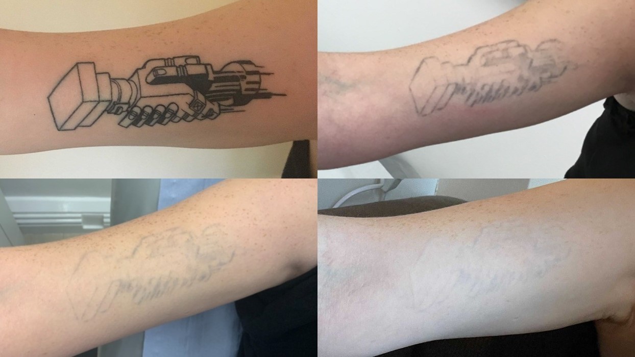 Everything you’ve ever wanted to know about laser tattoo removal Dazed