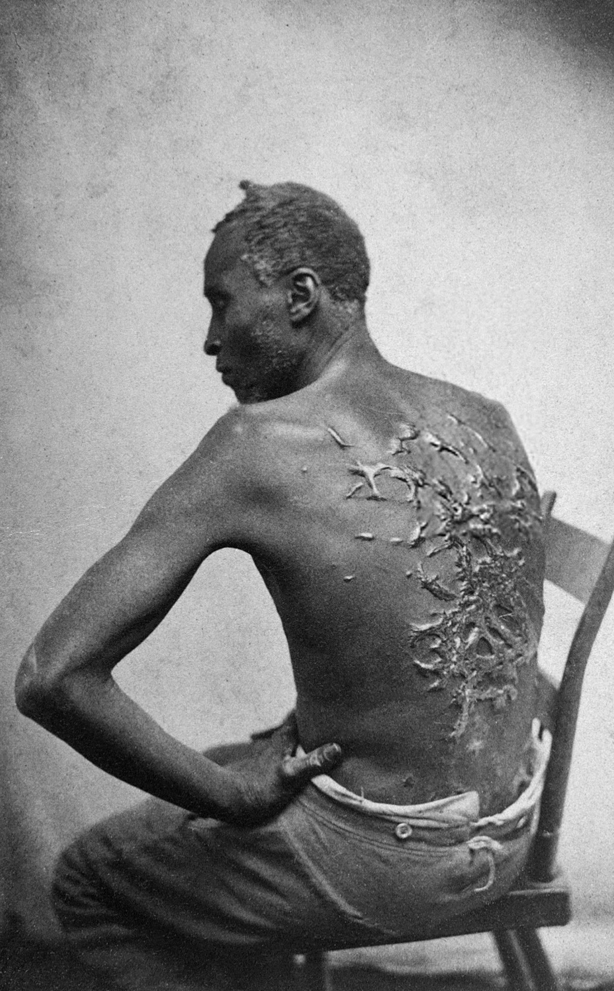 Mathew Brady, “Gordon, scourged back” (1863)