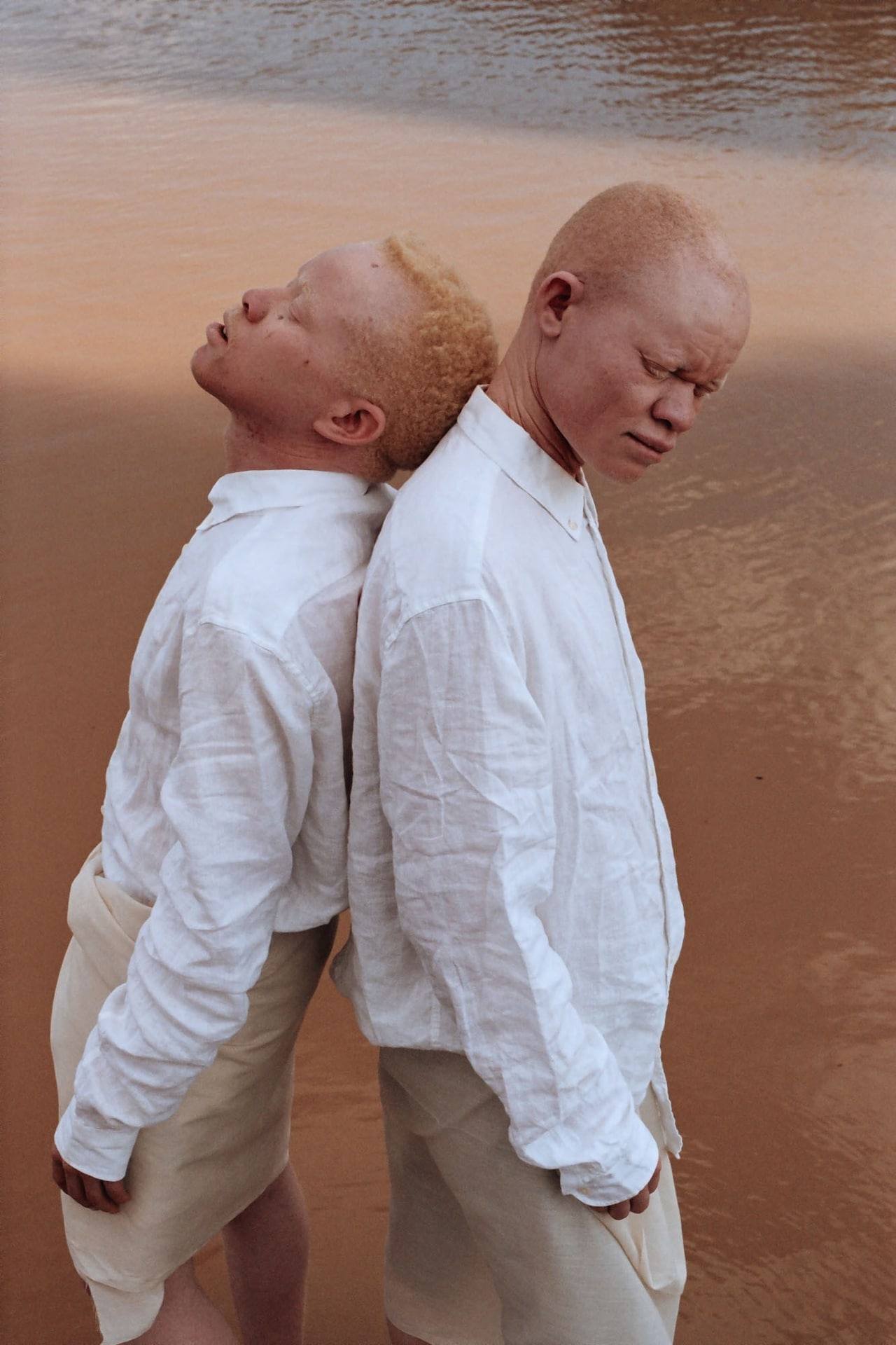 Albinism, photography Denisse Ariana Pérez