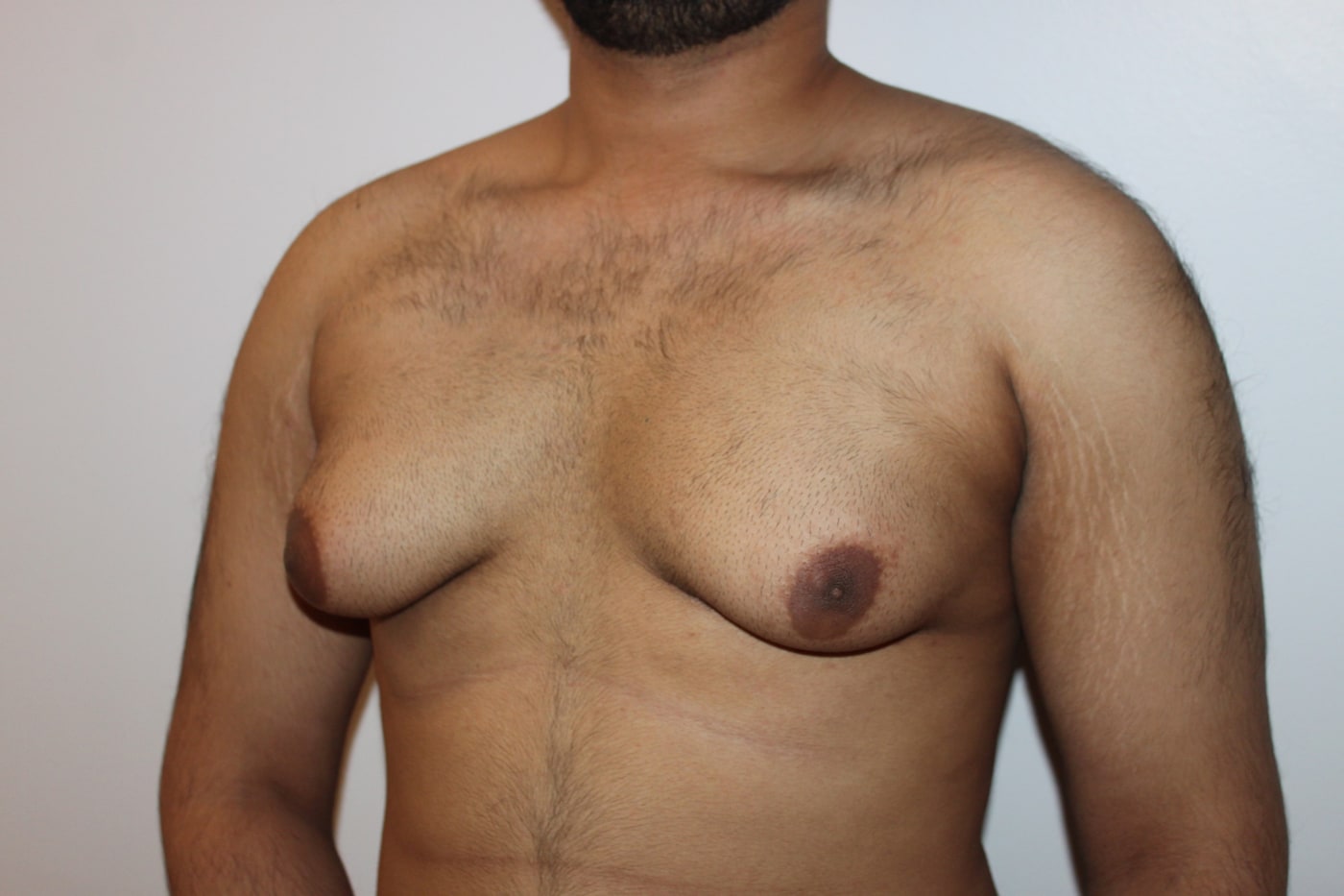 Gynaecomastia