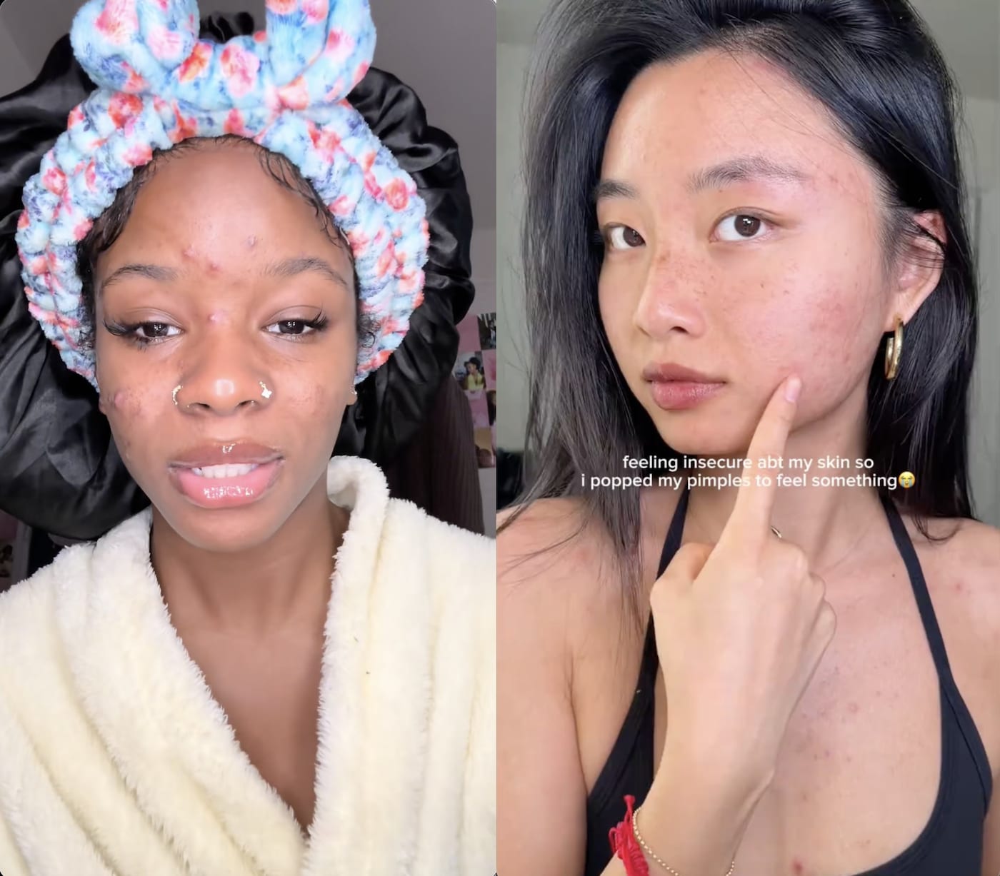 Acne pimple popping tiktok 