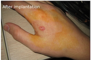 Implantation and healing 