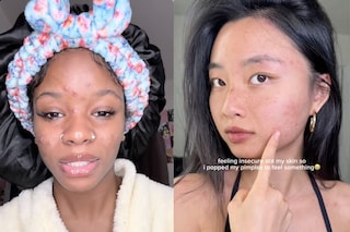 Acne pimple popping tiktok 