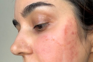 the ordinary deciem aha peeling solution chemical burn 