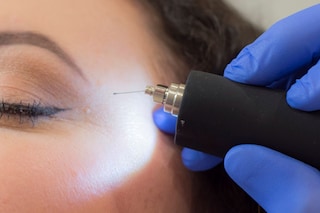 Plasma pen treatment