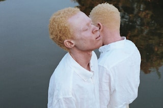 Albinism, photography Denisse Ariana P&#233;rez