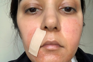 the ordinary deciem aha peeling solution chemical burn 