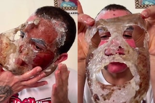 Phenol peel TikTok dangerous