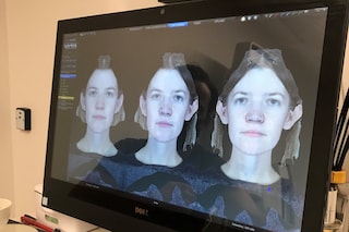 3d face scan treatment laser dr Costas Papageorgiou