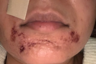 the ordinary deciem aha peeling solution chemical burn 
