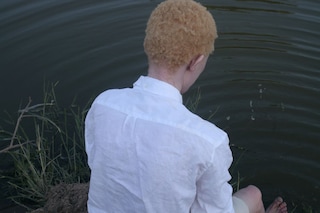 Albinism, photography Denisse Ariana P&#233;rez