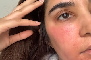 the ordinary deciem aha peeling solution chemical burn 
