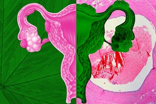 Endometriosis 3