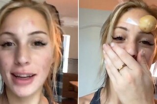 I used raw potato to treat my acne because of a TikTok trend