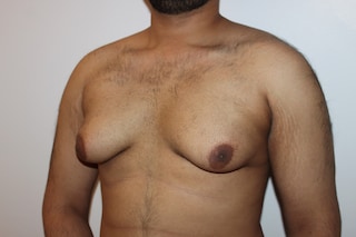 Gynaecomastia