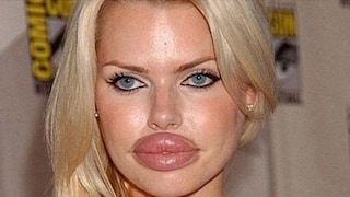 lip filler