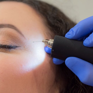 Plasma pen treatment