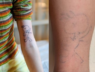 Ephemeral Tattoo made to fade two years later