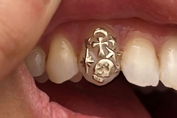 Chew on this: Tooth gems are now a 'thing