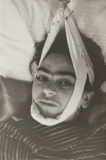 Frida Kahlo recovering from tram crash