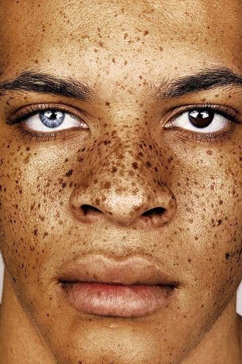 freckles on face