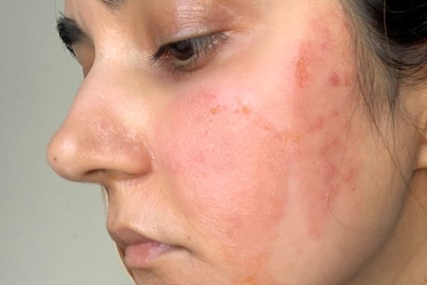 chemical burns on face
