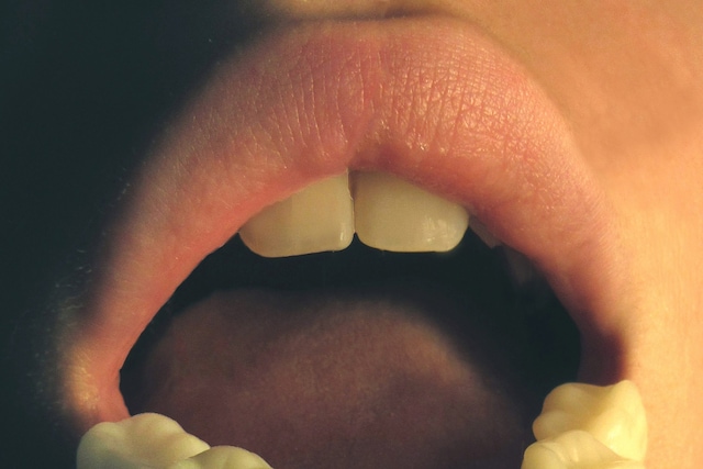 dent