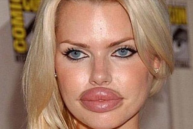 lip filler