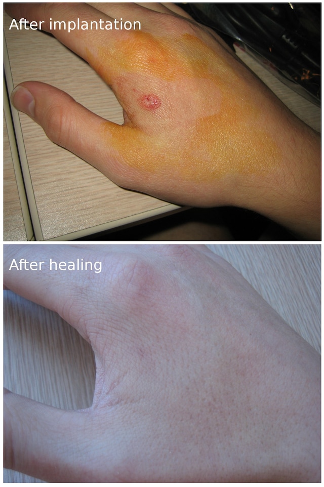 Implantation and healing 4