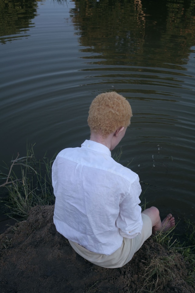 Albinism, photography Denisse Ariana P&#233;rez 1