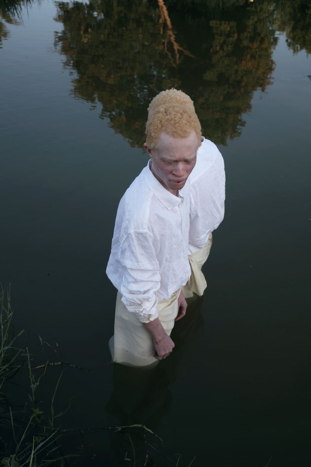Albinism, photography Denisse Ariana P&#233;rez 2