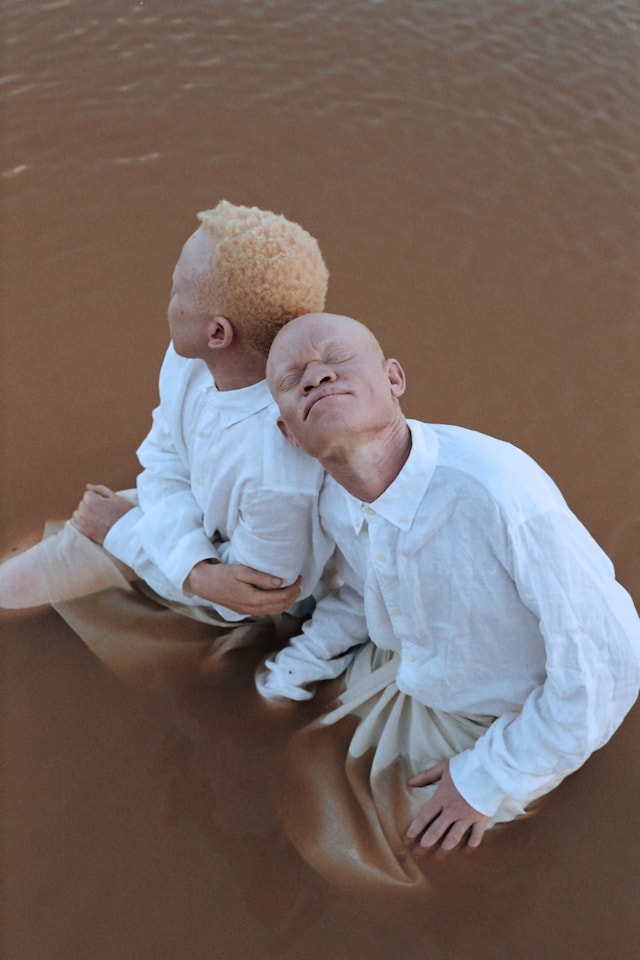 Albinism, photography Denisse Ariana P&#233;rez 6