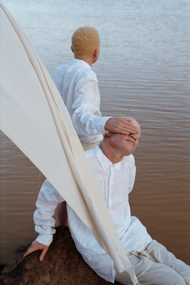 Albinism, photography Denisse Ariana P&#233;rez 7