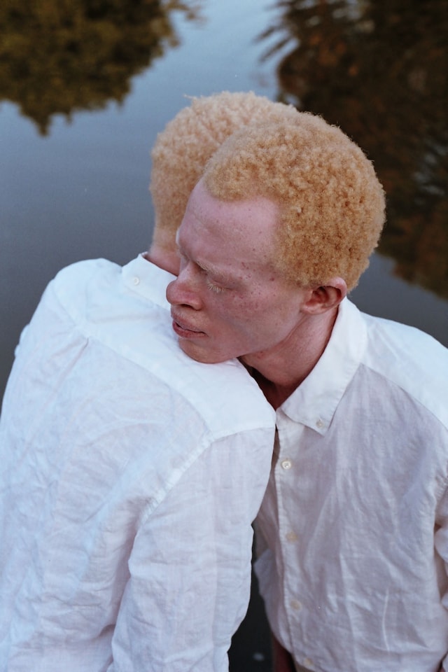 Albinism, photography Denisse Ariana P&#233;rez 8