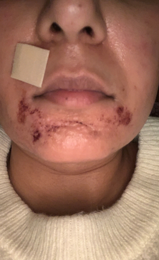 the ordinary deciem aha peeling solution chemical burn 0