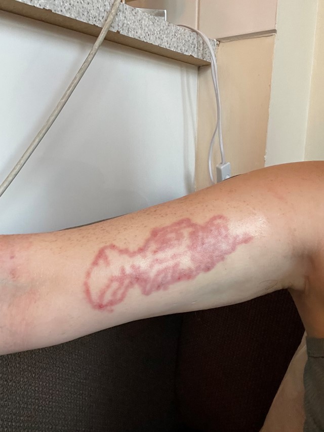 Tattoo laser removal healing