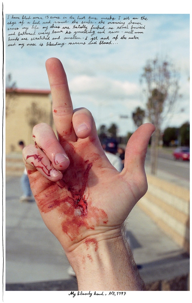 Ed Templeton, Self-portrait of an injured hand (1997) 10