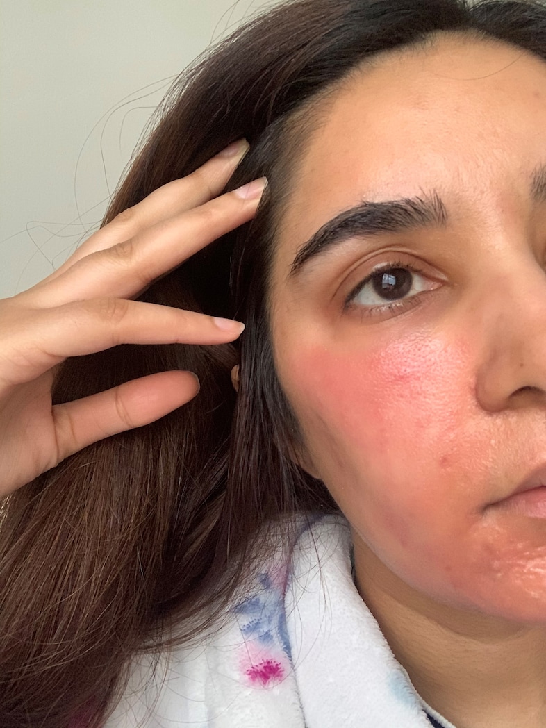 Sara Chaudhry chemical burns Dazed
