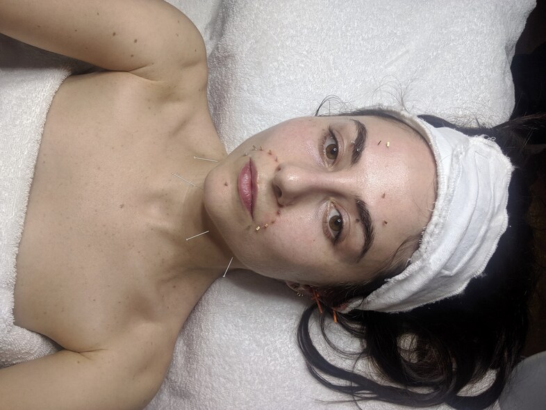 Nellie acupuncture
