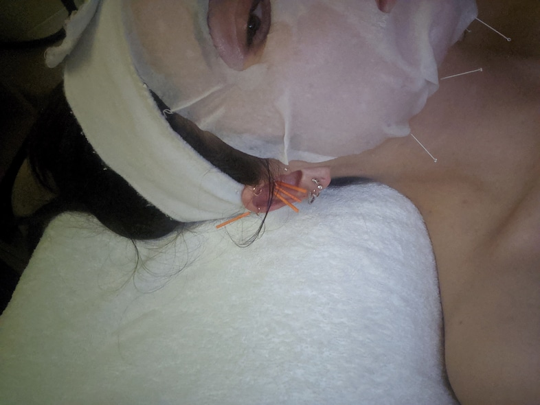 Nellie acupuncture