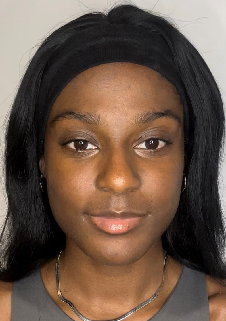 SHEI - SALMON DNA FACIAL - AFTER
