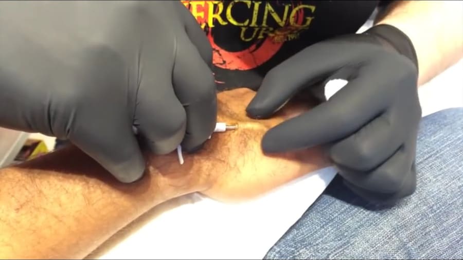 Inserting the microchip 2