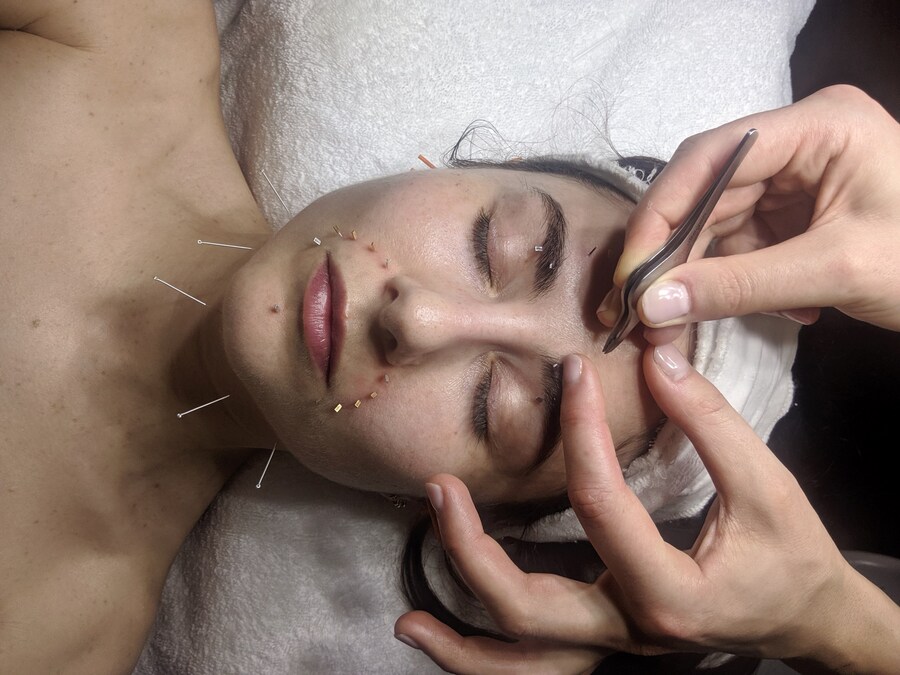 Nellie acupuncture