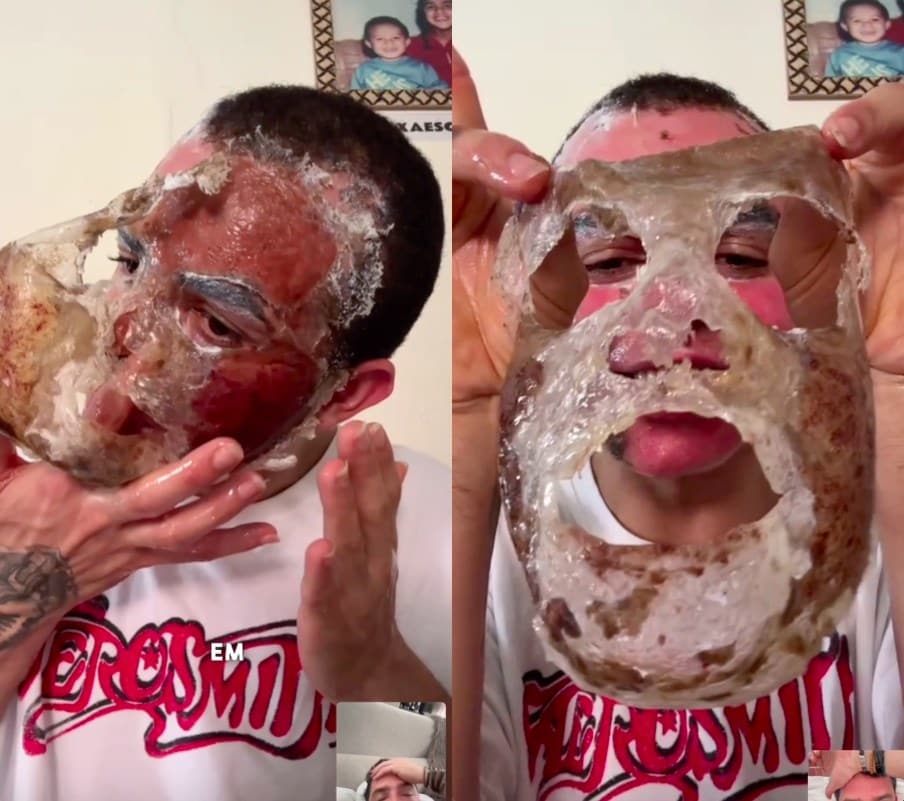 Phenol peel TikTok dangerous